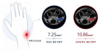 국제성모병원 김영욱 교수, 손목 힘줄염 객관적 MRI 진단 기준 제시